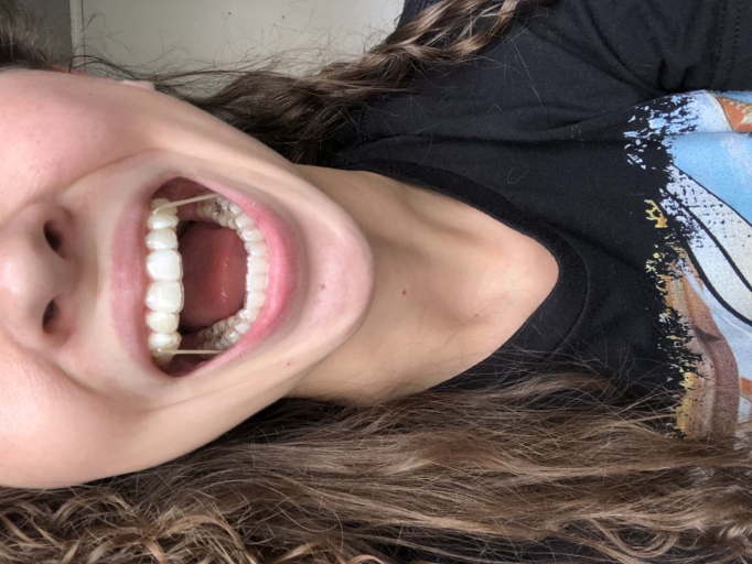 Invisalign with Rubber Bands
