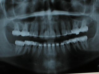 Before Jaw Surgery X-ray