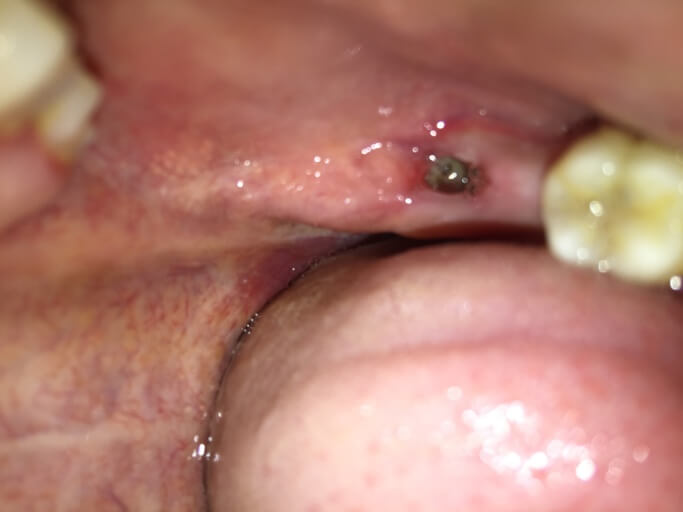 Dry Sockets After Tooth Pulled