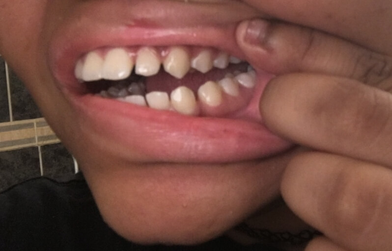 Need Braces?