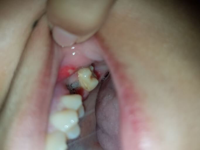 dry socket after extraction