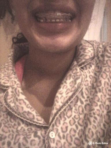 taking braces off