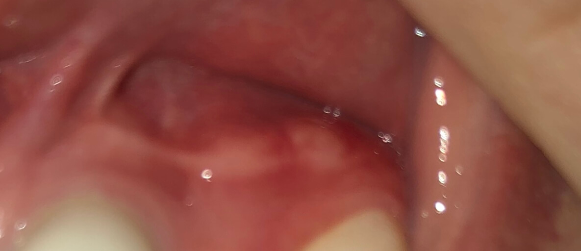 white bumps on gums