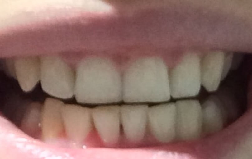 gap in teeth