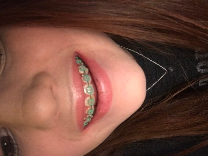 braces with green rubber bands