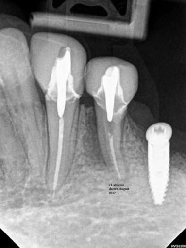 Root Canal Xray