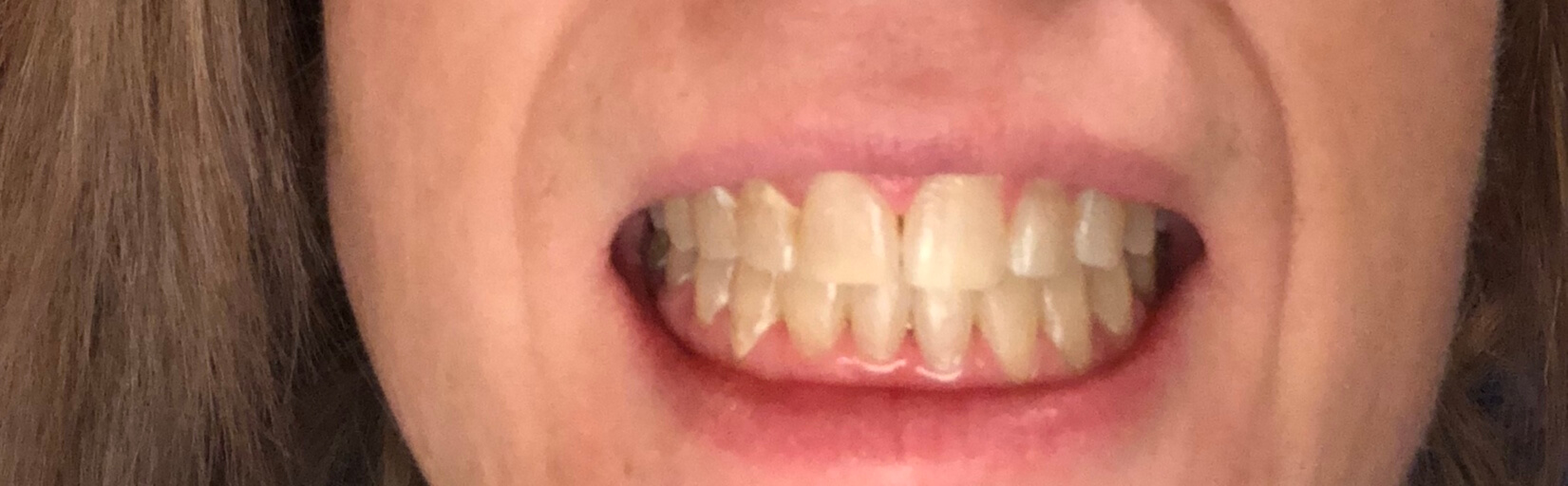 gaps after braces