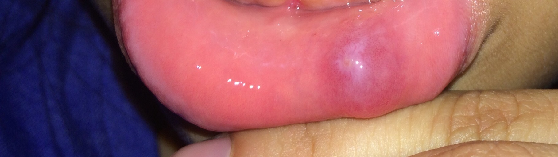 Canker Sore