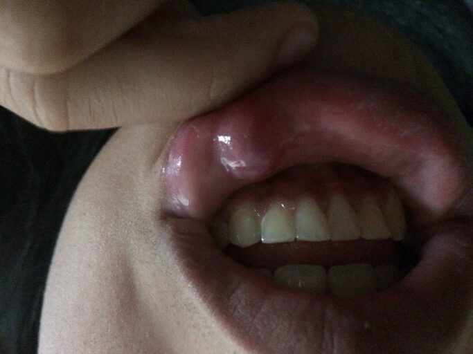 Canker Sore