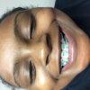 Sharp Wires in Braces