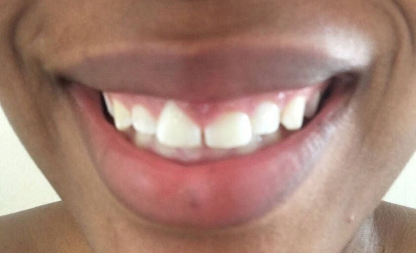 Shape of gums