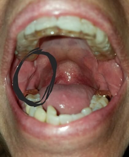 frenulum between gums