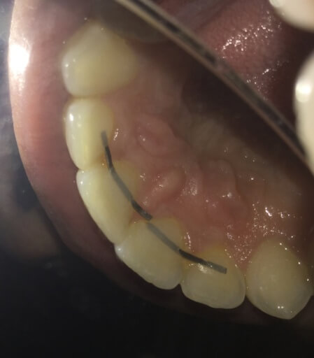 Permanent Retainer