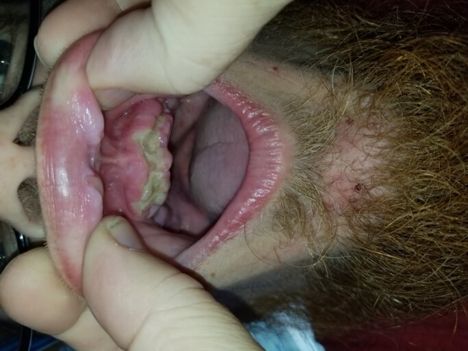 All Teeth Extracted
