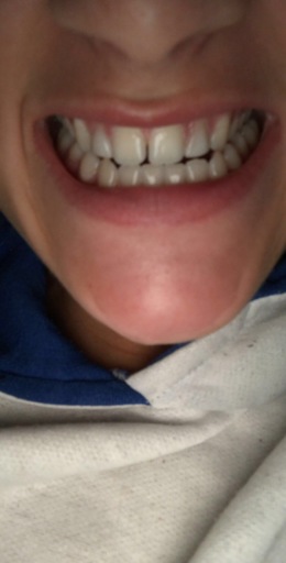 underbite