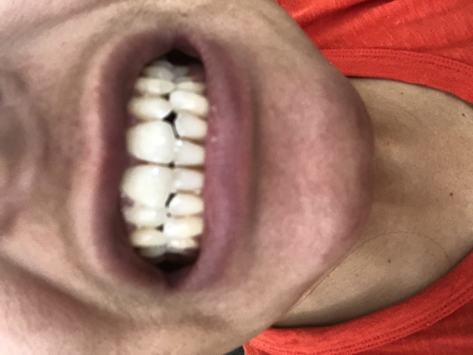 Edge to Edge bite