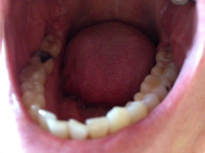 Does An Air Bubble In A Filling Need To Be Replaced Does An Air Bubble In A Filling Need To Be Replaced