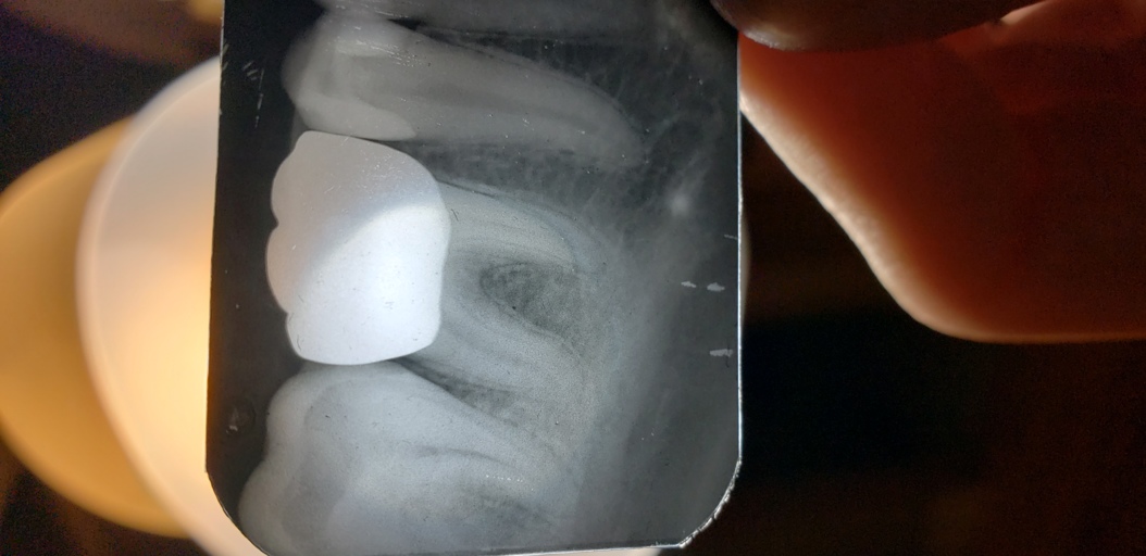 Crowned Tooth Crowned Tooth