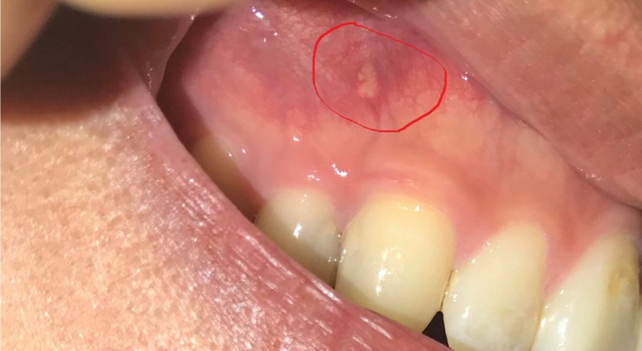 White Spot On Gums