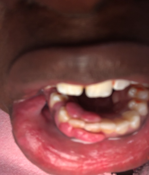My gum is growing over my teeth