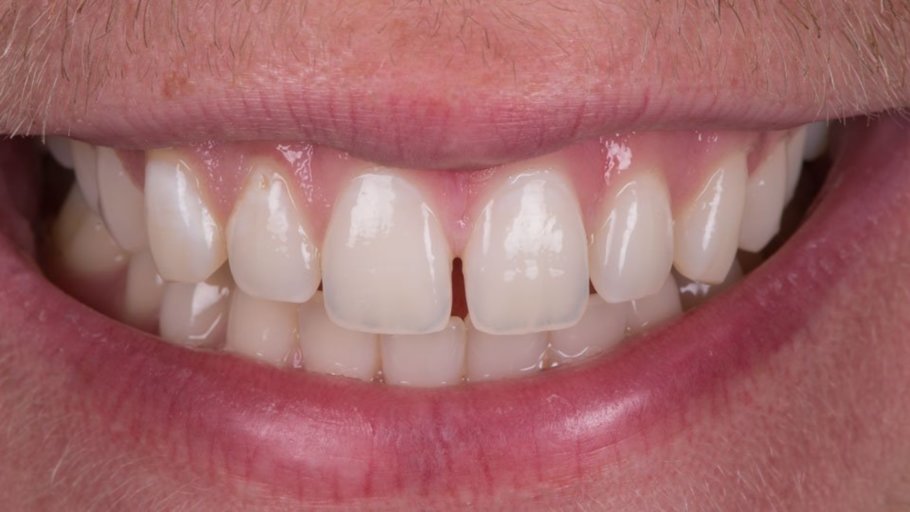 Shifted bottom teeth post braces Shifted bottom teeth post braces
