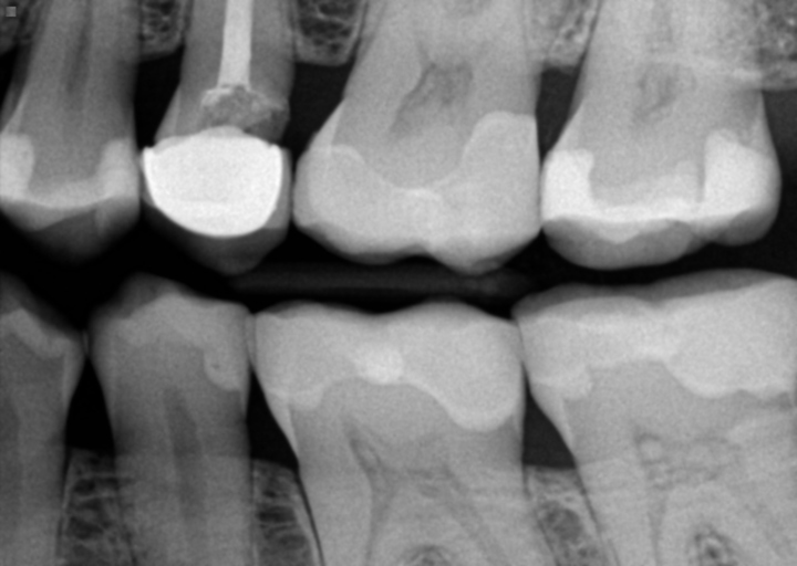Can mri be done with dental crowns