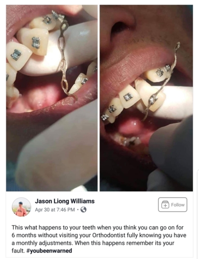 braces retainer