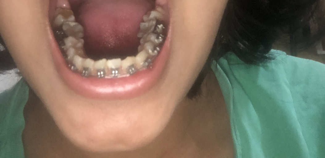 teeth slanted jaw inwards ligatures bracesinfo