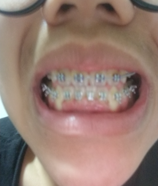 braces gums gum overgrown gingivitis swelling ulcers persistent bracesinfo chills