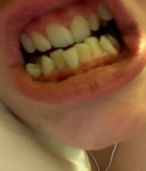 gingivitis gums braces ulcers swelling overgrown chills persistent bracesinfo