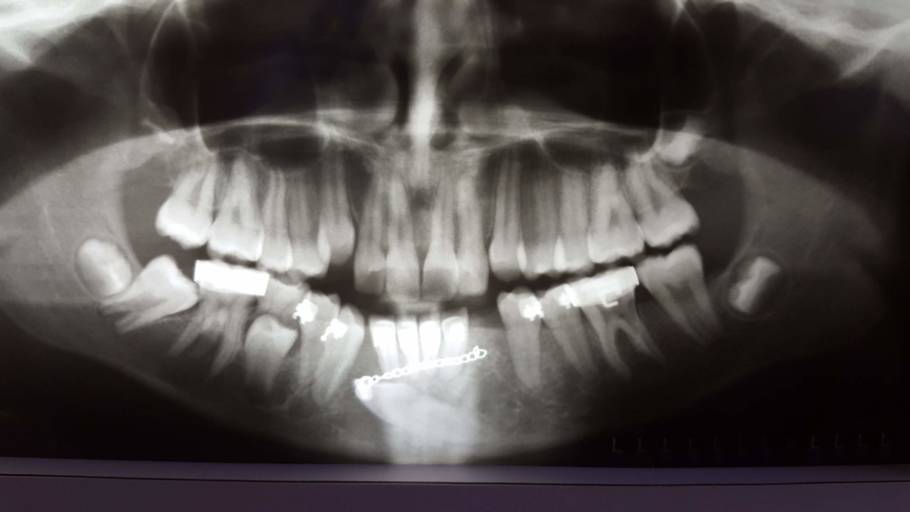 Why Do My Teeth Hurt so Bad?