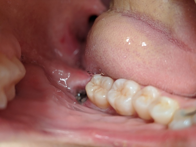 How long will my mouth be sore after dry socket?