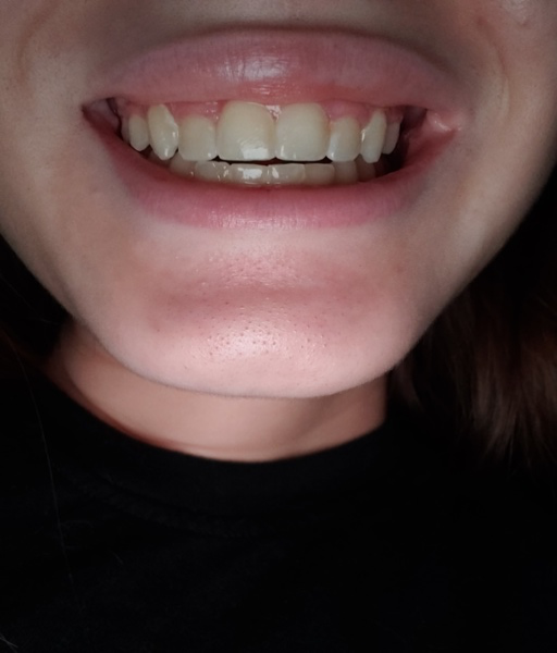 braces orthodontist slanted occlusion retainers bracesinfo