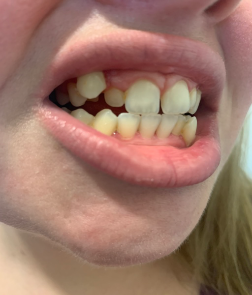 gums braces swelling orthodontist bracesinfo incisor