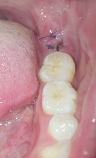White Chunk Under Suture Following Wisdom Teeth Extaction