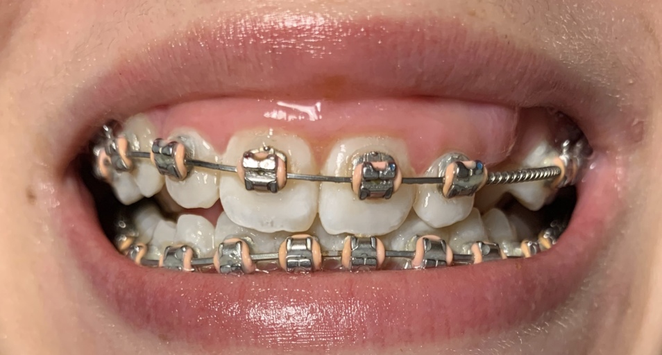 How do I take my braces off at home?