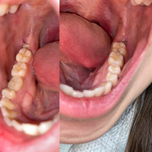 Taking Plan B pill 3 days prior to wisdom teeth extraction