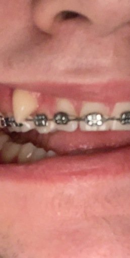coil orthodontics mamelons retainer reshaping inwards gums misplaced receding bracesinfo orthodontist