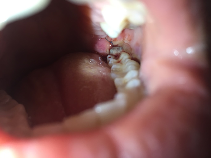 Healing Process After Wisdom Teeth Removal Normal Or Infected