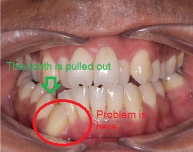 crooked incisors retainer shifted solution invisalign bracesinfo