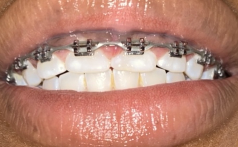 gums swelling bracesinfo