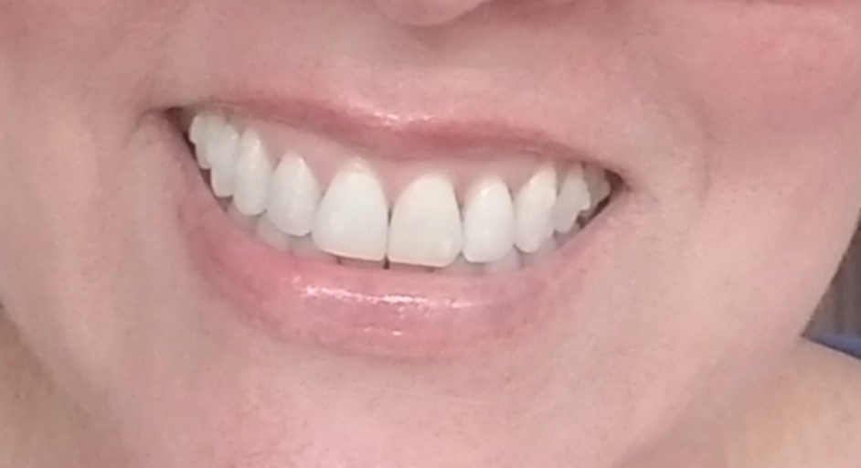 osteoporosis invisalign incisors braces shifted bracesinfo