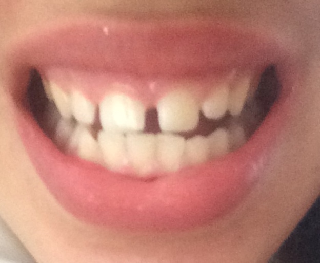 How would I fix my lateral incisors that have shifted ...