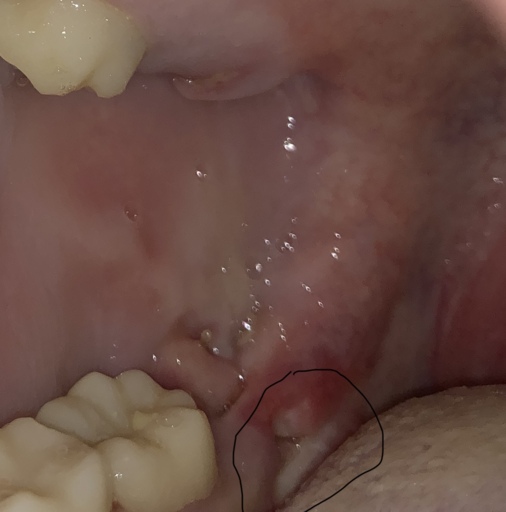 White spot on gum after wisdom teeth extraction