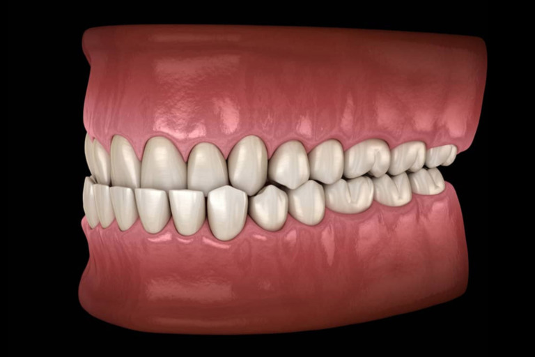 incisors shifted invisalign