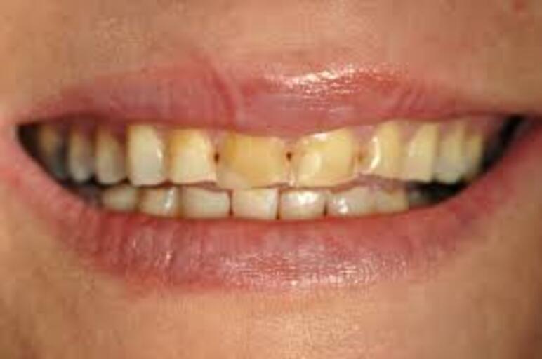Brown sticky stuff on front teeth