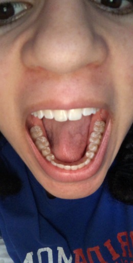 tooth sealants molars