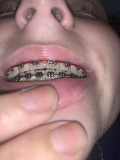 braces retainers tmj dentist lollipops disorder threatening bracesinfo