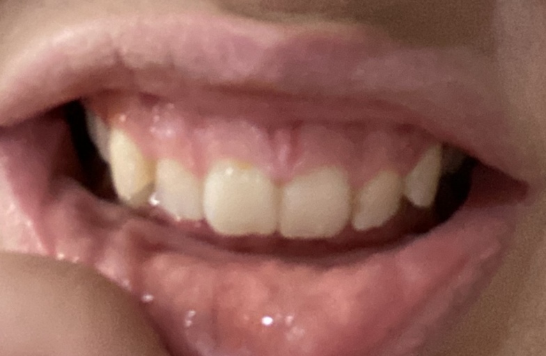 White Spot On Gums