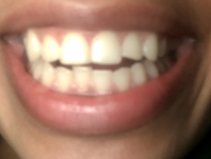 i had braces and my teeth shifted i had braces and my teeth shifted